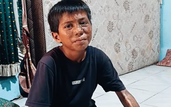 Potret Pilu Anak Miskin di Tanjung Atap Barat, Putus Sekolah, Tubuh Terbakar, Hidup Ditinggal Ibu, Bertahan dengan Belas Kasih Tetangga